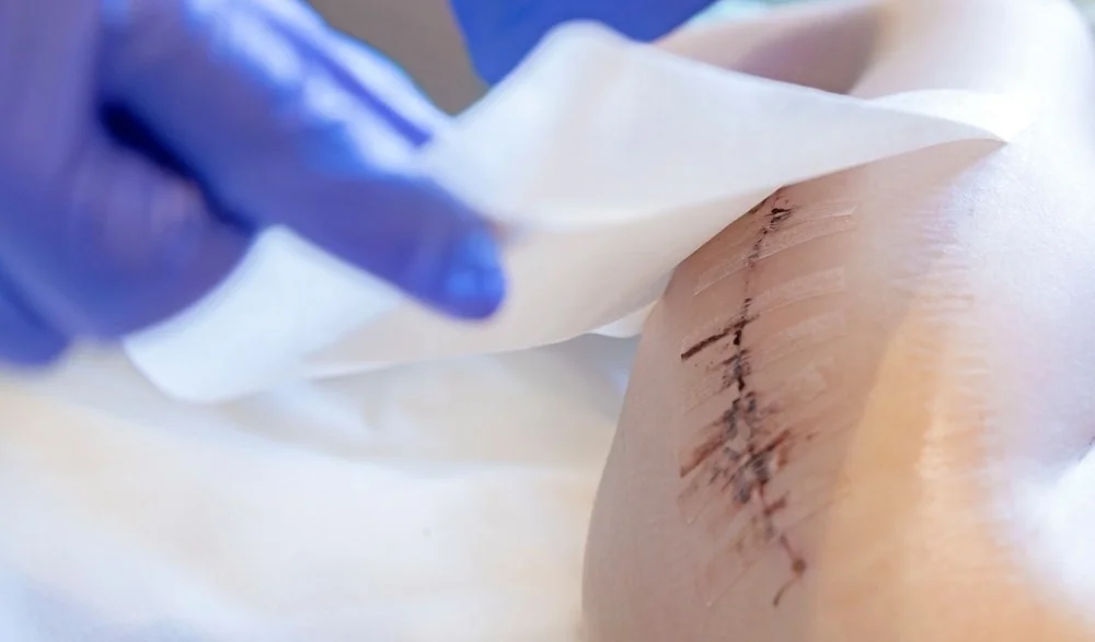 How to Effectively Use Silicone Scar Tape for Optimal Results