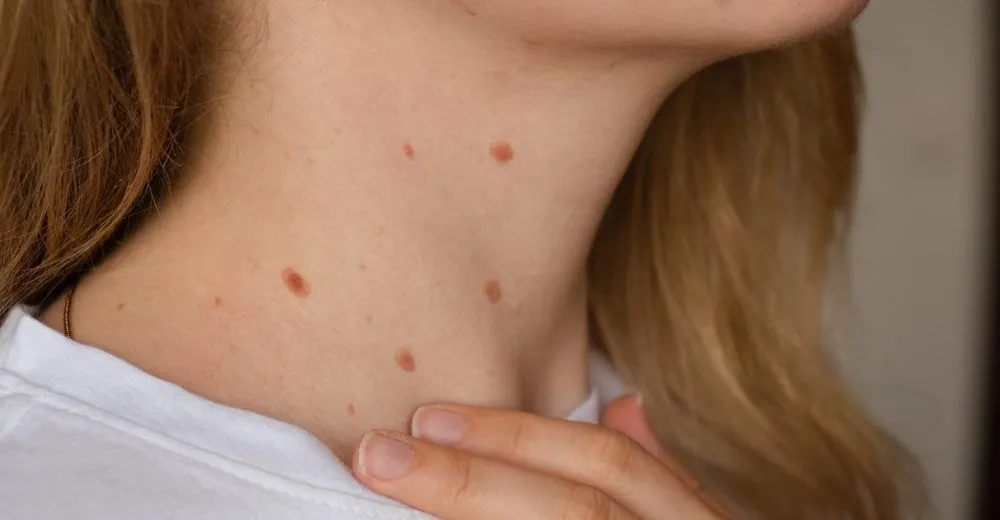 What Are Genital Skin Tags?